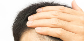 PRP capelli, nuove frontiere contro la calvizie prp capelli