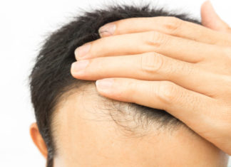 PRP capelli, nuove frontiere contro la calvizie prp capelli